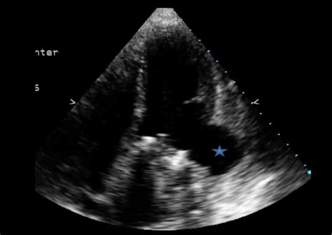 aneurysm vs pseudoaneurysm echo